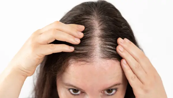 hairloss