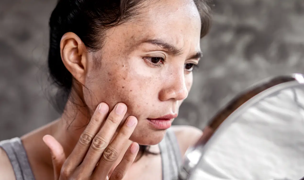 melasma and vitamin deficiency