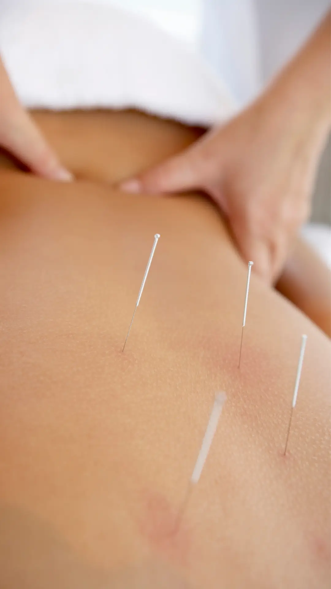acupuncture