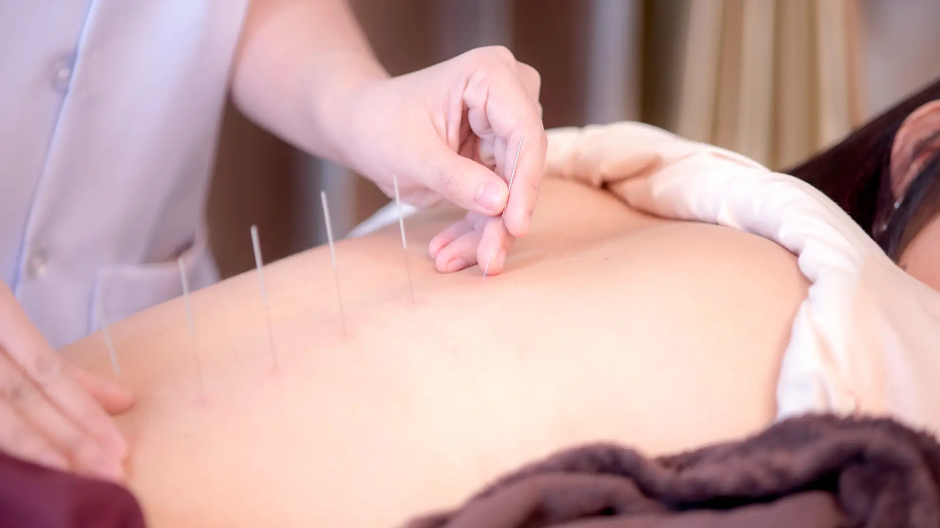acupuncture in carson