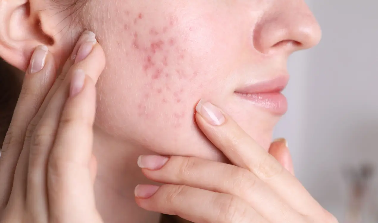 Acne Scar Treatment in Carson, CA