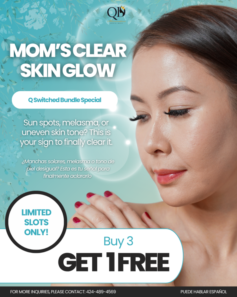 Q Switched Laser for Melasma & Sun Spots Mother's Day