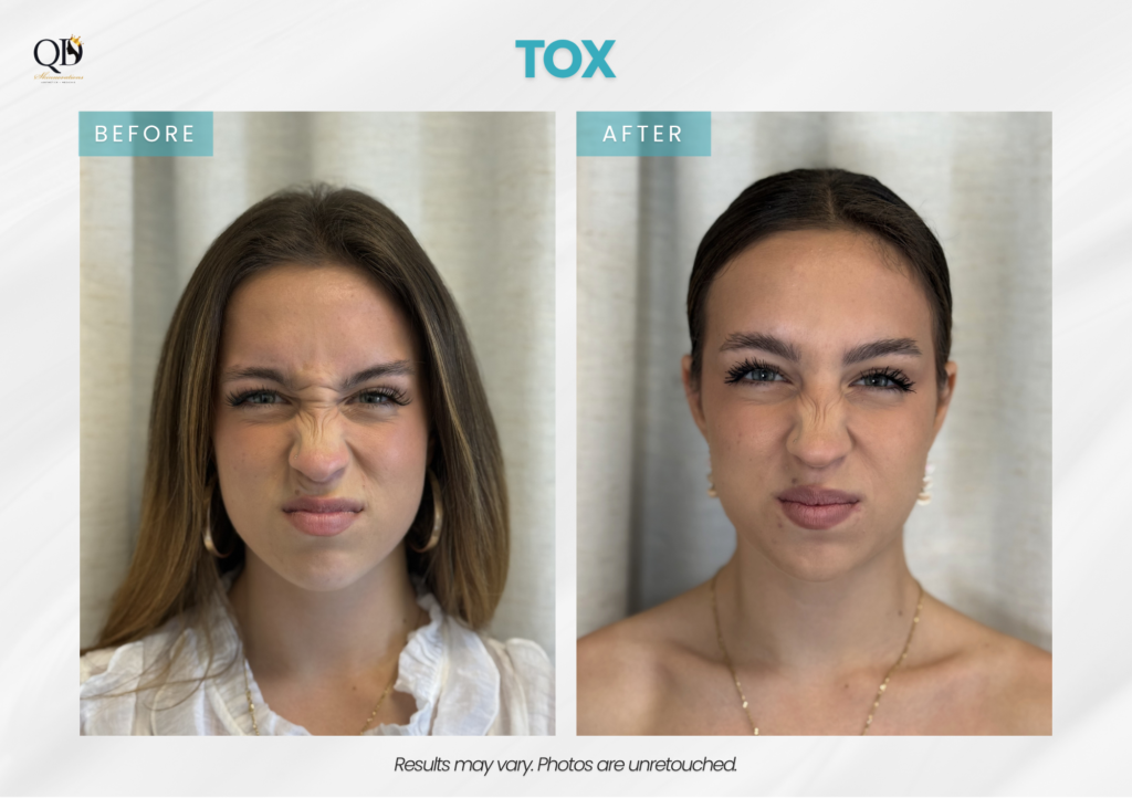 Before-and-after Botox treatment for bunny lines at QD Skinnovations in Carson, CA