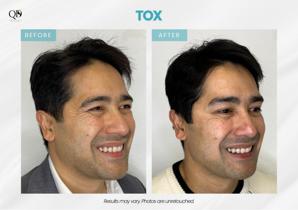Before-and-after Botox treatment for crow’s feet around the eyes at QD Skinnovations in Carson, CA