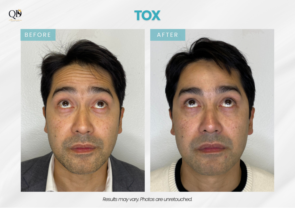 Before-and-after Botox treatment for forehead lines at QD Skinnovations in Carson, CA
