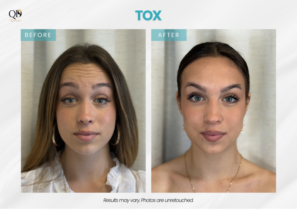 Before-and-after Botox treatment for forehead lines at QD Skinnovations in Carson, CA